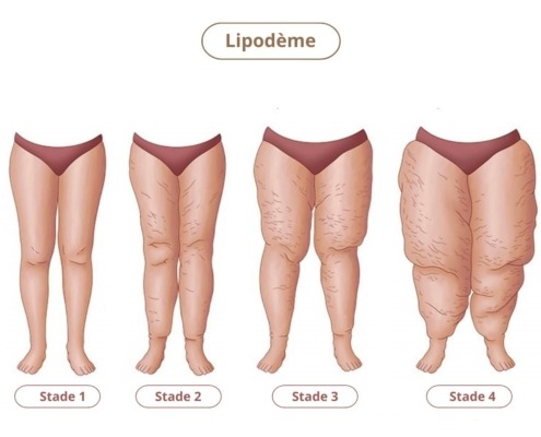 lipoedème